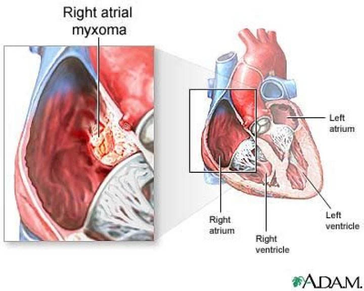 Are atrial myxomas hereditary?