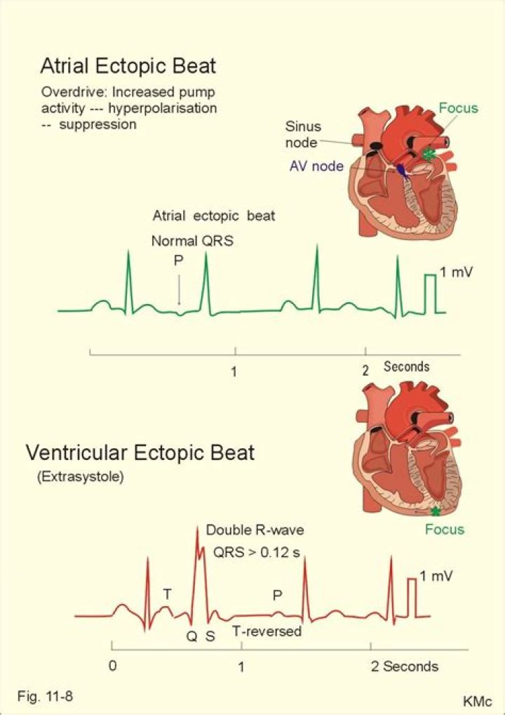 Are ectopic beats normal?