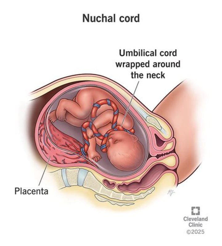 Are nuchal cord dangerous?