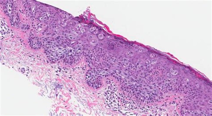 Are squamous cell carcinomas malignant?