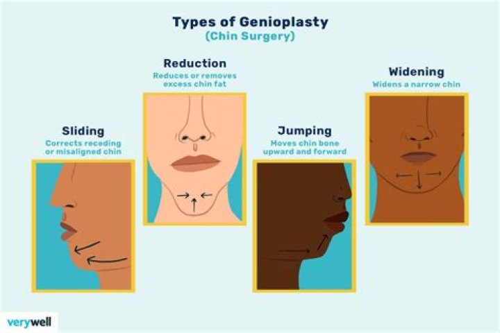 Can a sliding genioplasty be reversed?