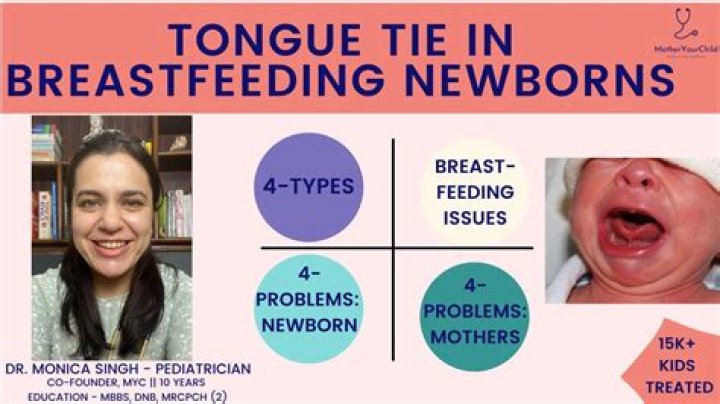 Can babies grow out of tongue tie?