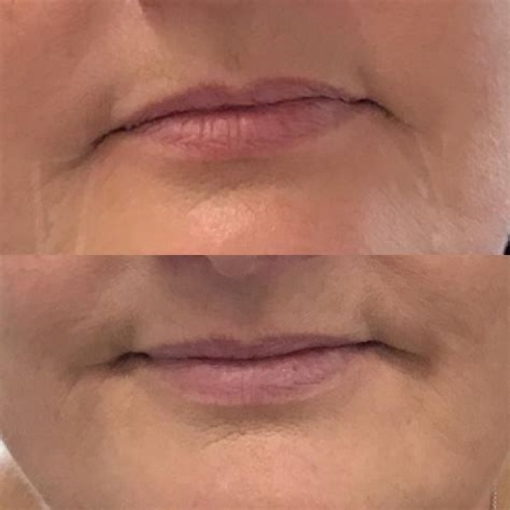 Can botox help downturned mouth?