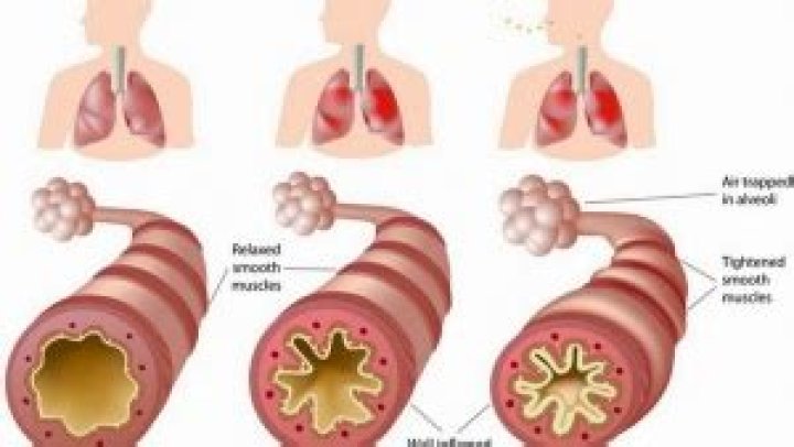 Can chronic bronchitis be cured?