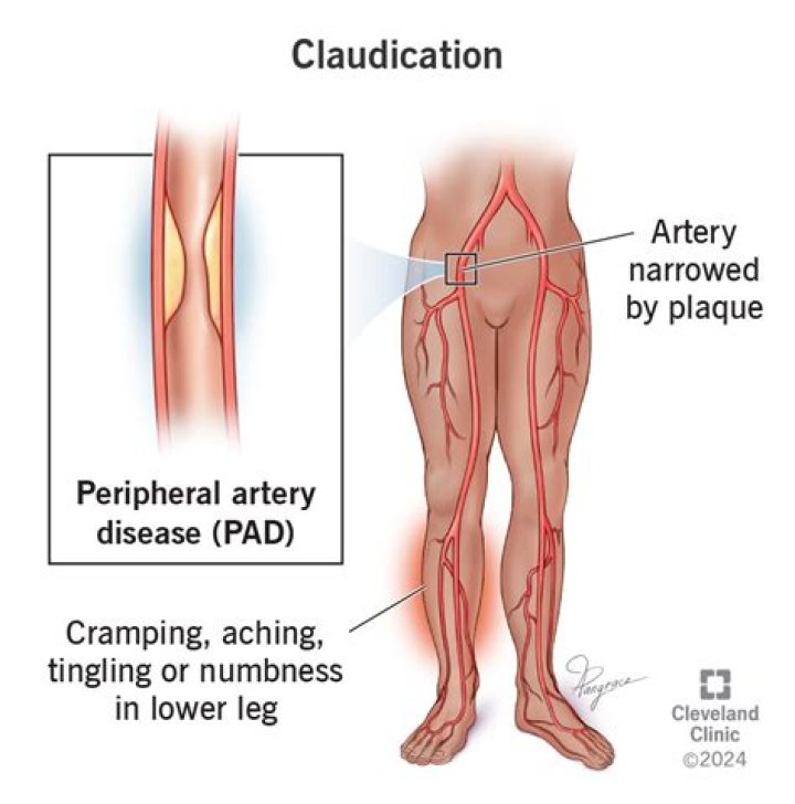 Can claudication be reversed?