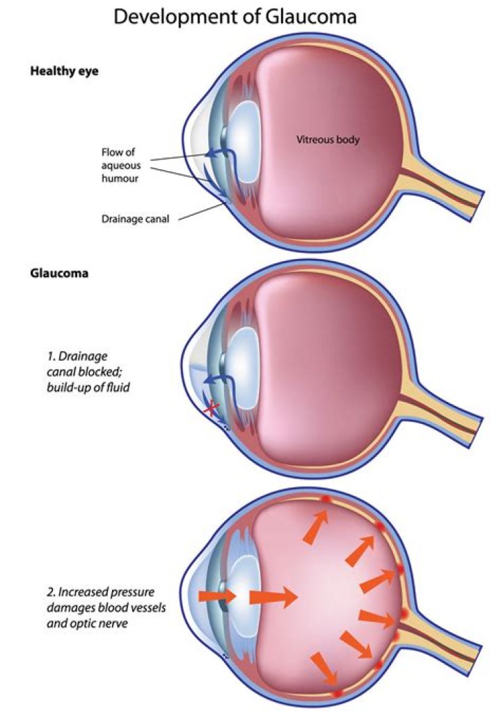 Can glaucoma be cured?