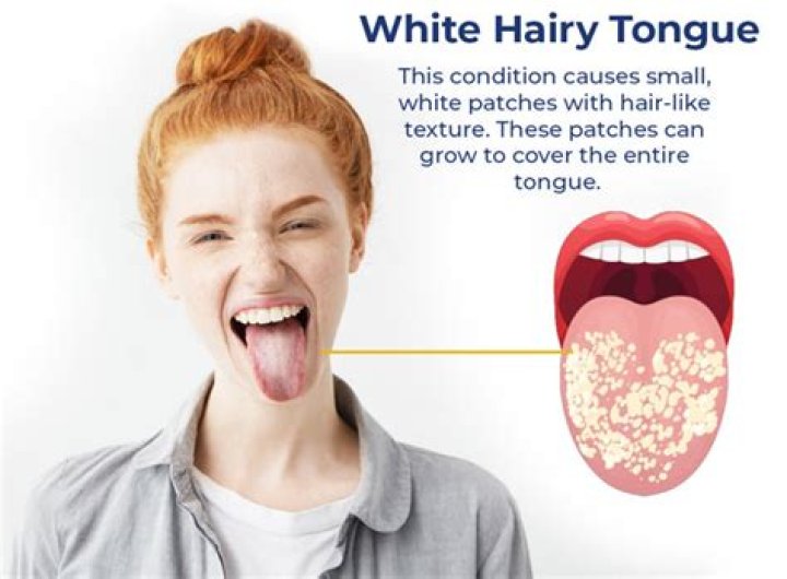 Can hairy tongue be white?