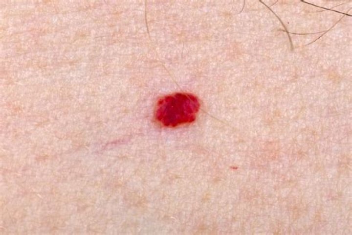 Can hemangioma grow back?