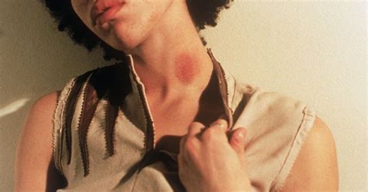 Can hickeys give you cancer?