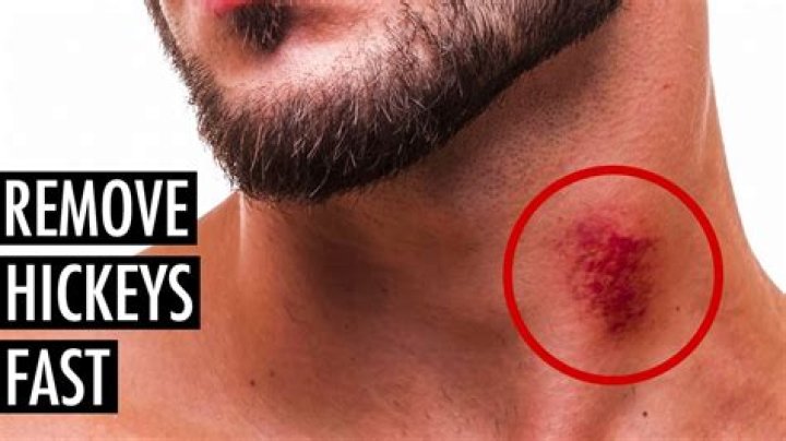 Can hickeys go away overnight?