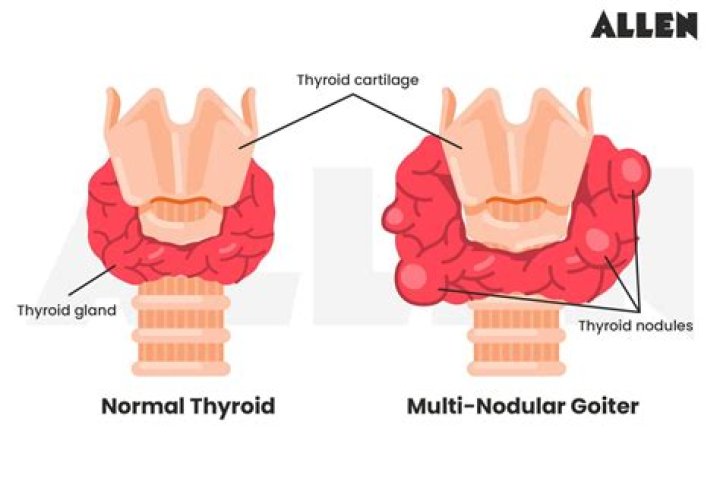 Can multinodular goiter shrink?