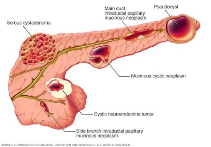 Can pancreatic pseudocysts become cancerous?