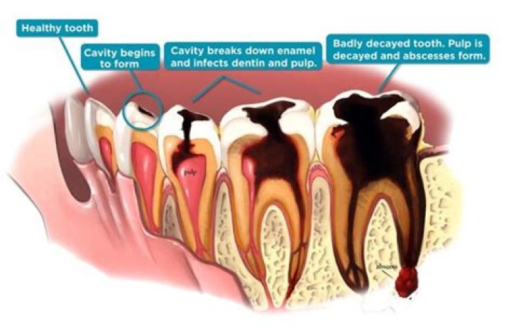 Can rotting teeth cause cancer?