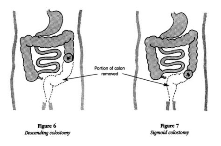 Can sigmoid colon be removed?