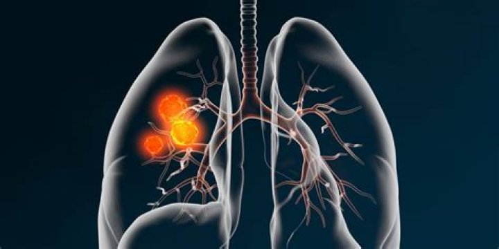 Can sputum test detect lung cancer?
