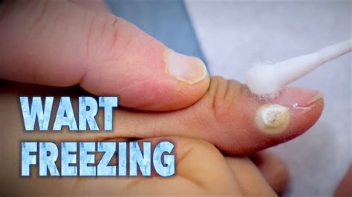 Can you freeze periungual warts?
