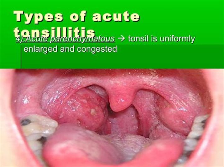 Can you have exudate without tonsils?