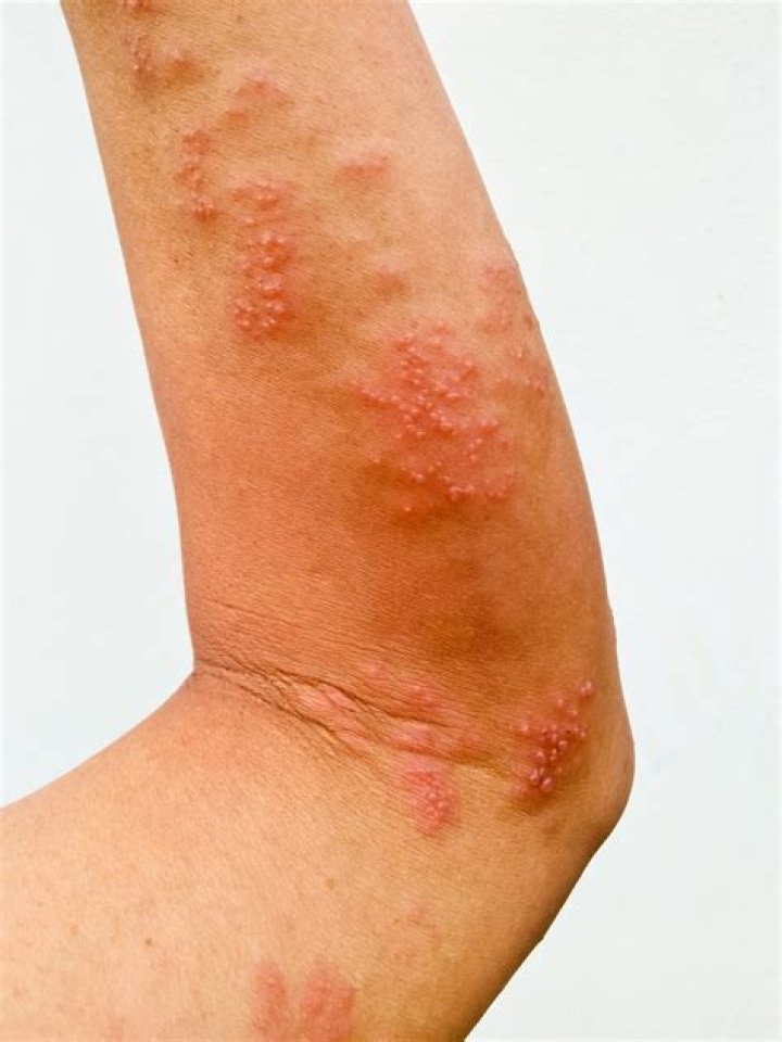 Can you have shingles on your arm?