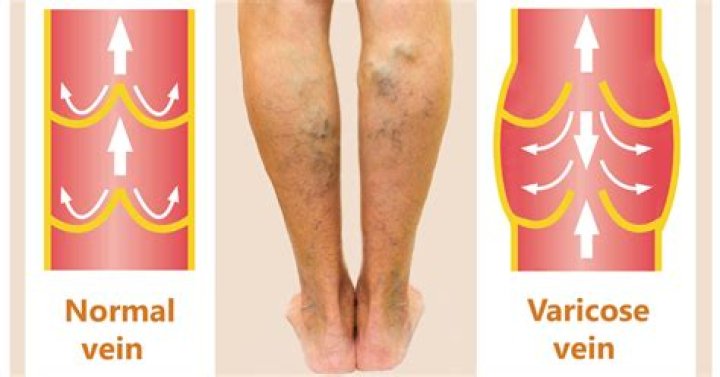 Do scarred veins heal?