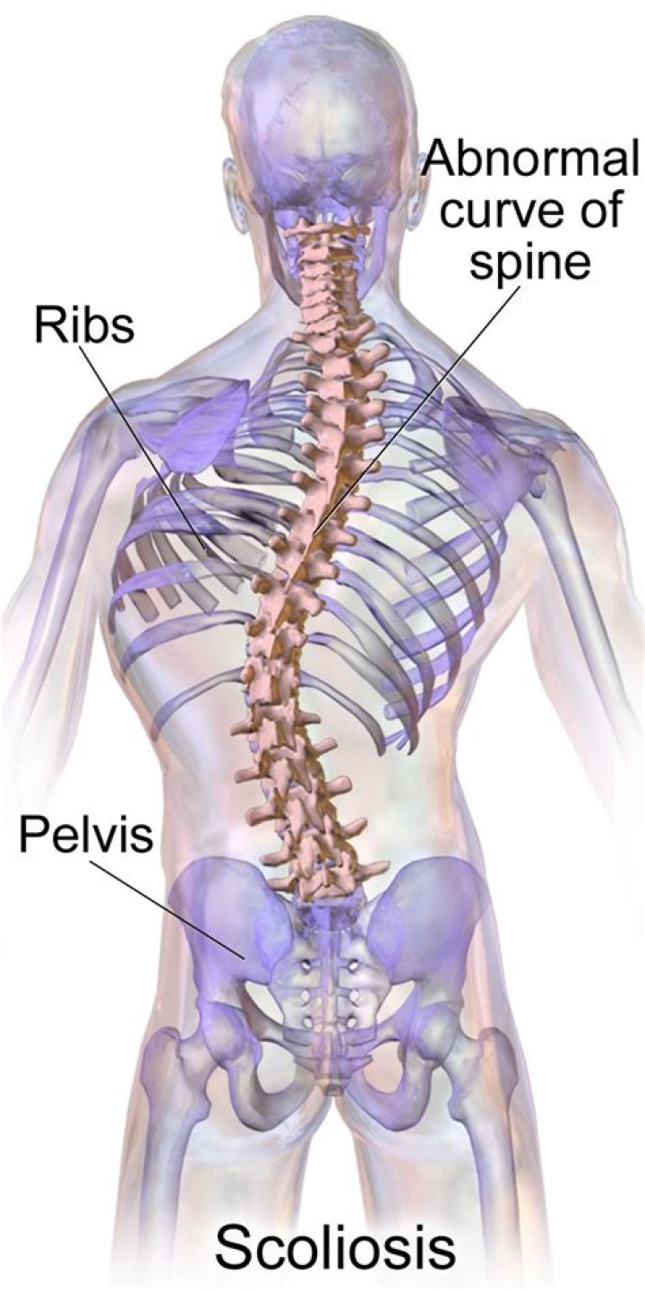 Do scoliosis cause back pain?