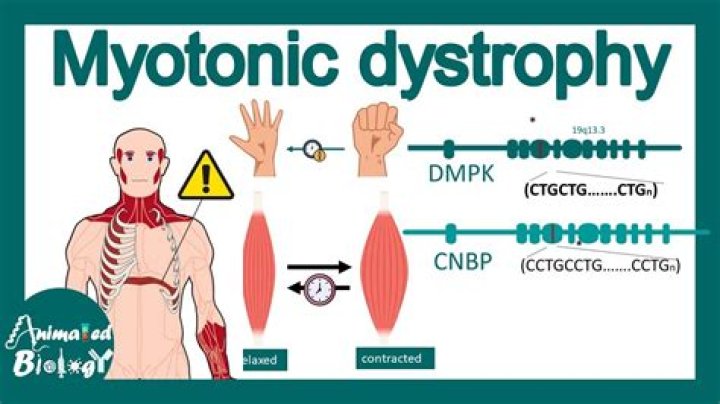 Do you inherit myotonic dystrophy?