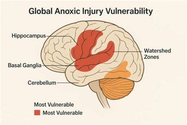 Does anoxic brain injury cause swelling?