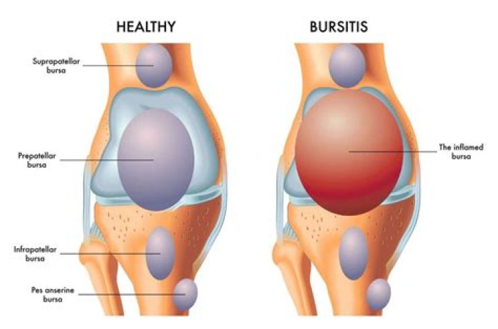 Does bursitis go away?