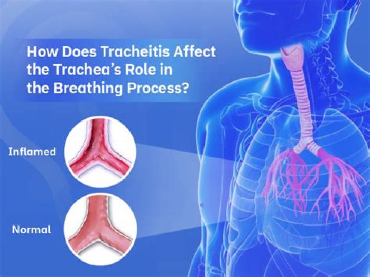 Does covid cause tracheitis?