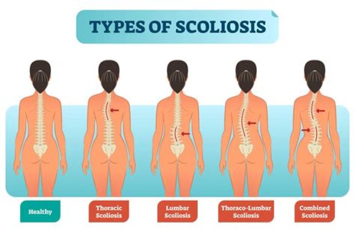 Does everyone have scoliosis?