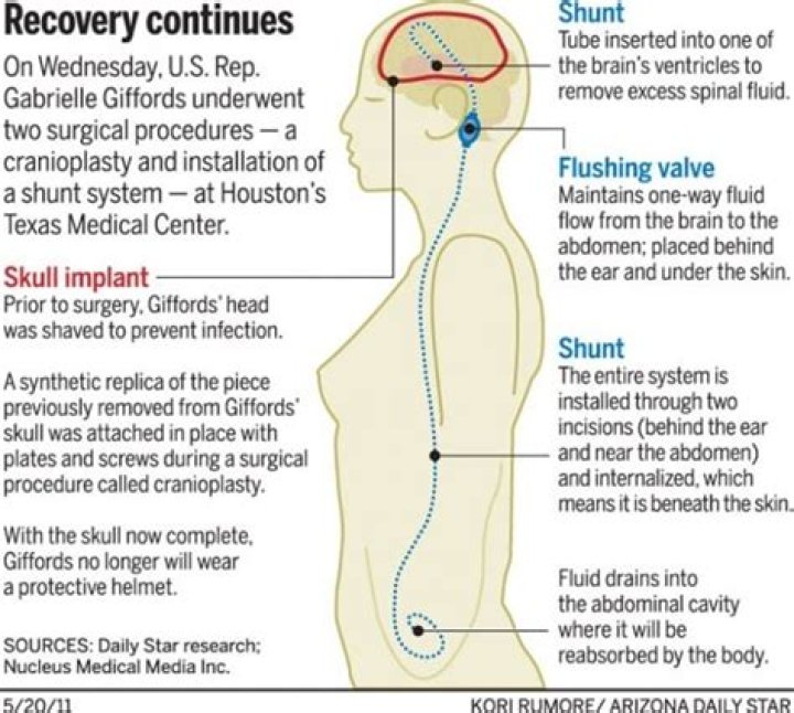 Does gabby gifford have brain damage?