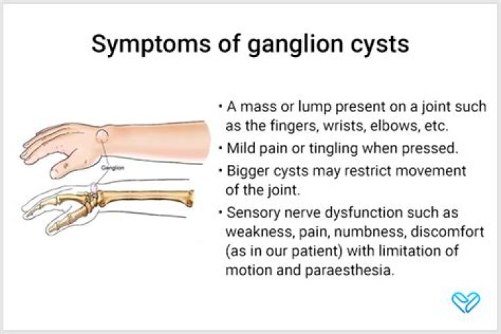 Does ganglion cyst feel like a bone?