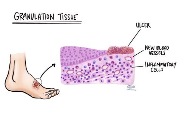 Does granulation tissue hurt?