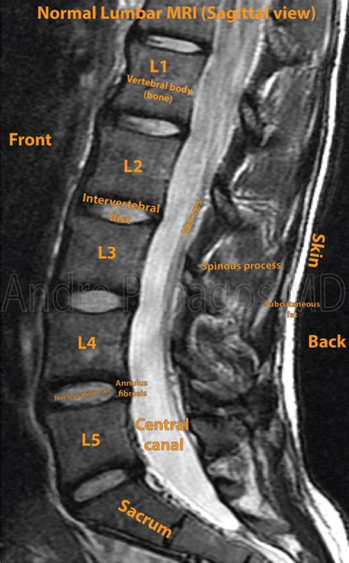 Does lumbar mri show sacrum?