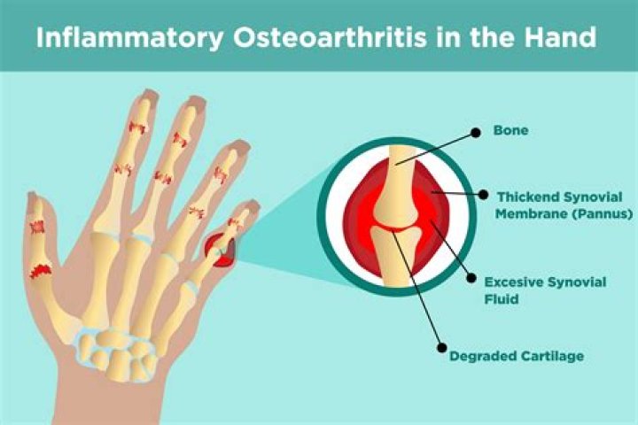 Does osteoarthritis cause disfigurement?