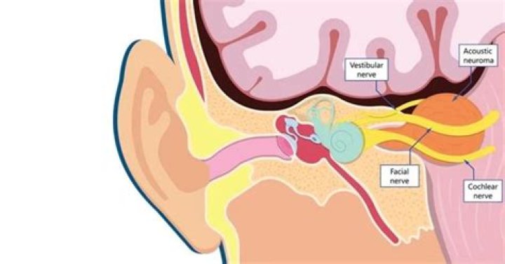 Does ringing in ears mean brain tumor?