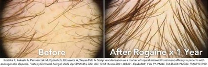 Does rogaine have to be used twice a day?