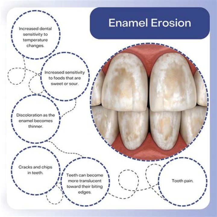 Does scaling damage enamel?