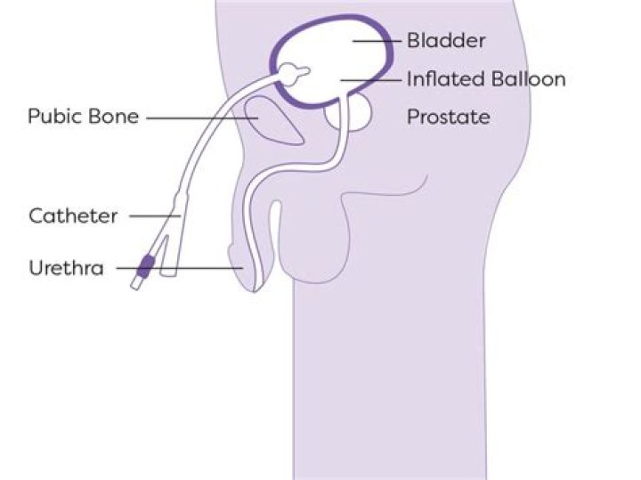 Does self catheterization empty the bladder?