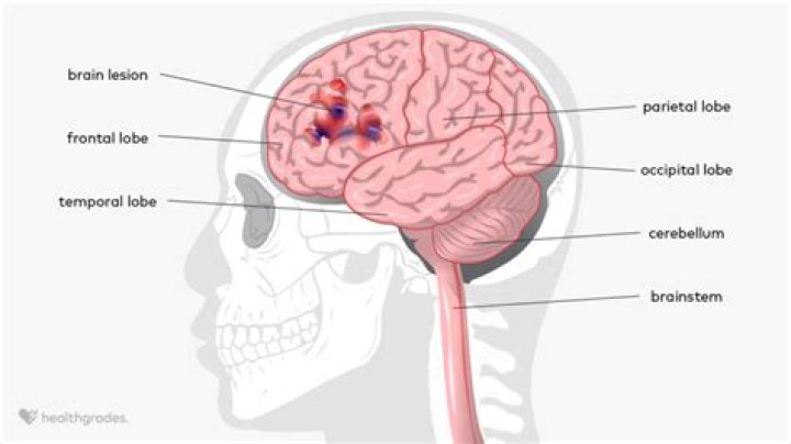 Does small forehead mean small brain?