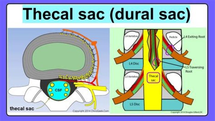 Does thecal sac compression cause pain?