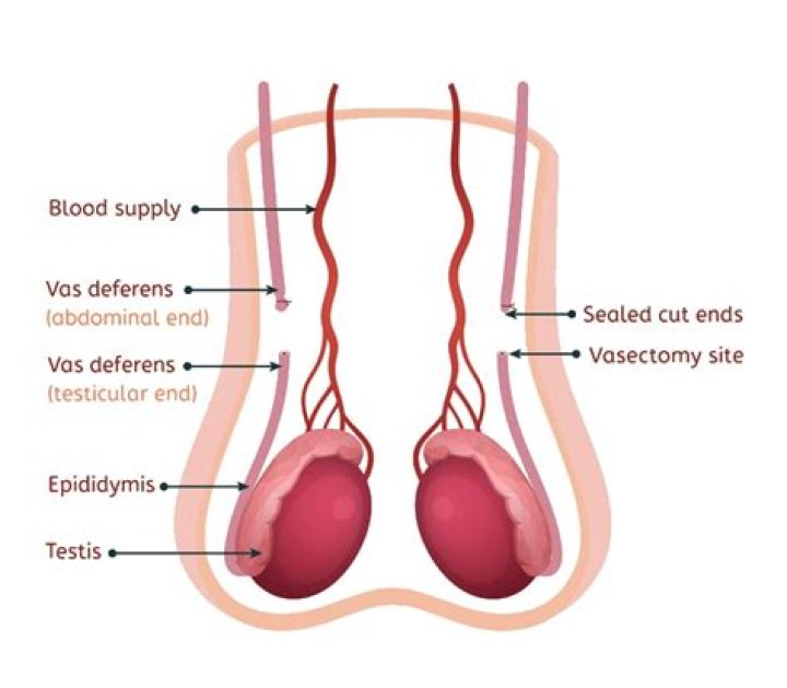 Does vasectomy cause back pain?