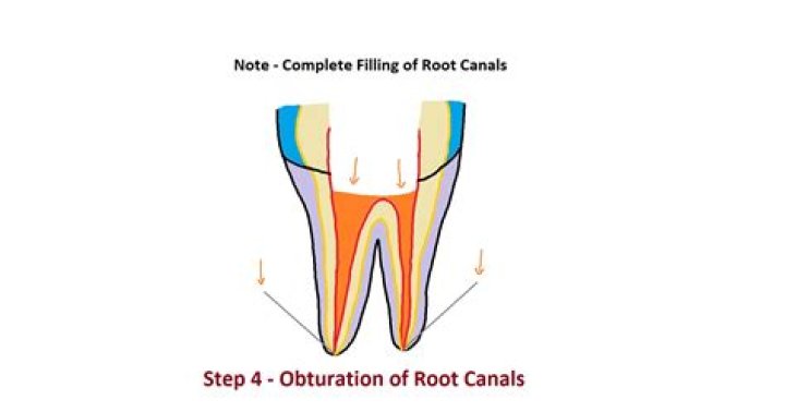 For root canal obturation?