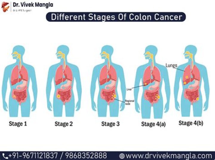 Has anyone survived colon cancer?