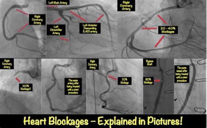 How are blockages of the coronary arteries treated?