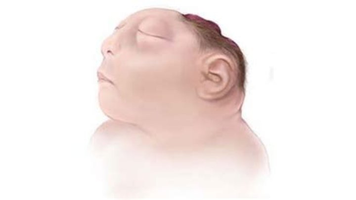 How do anencephalic babies die?