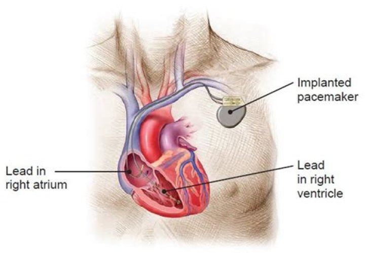 How does a dual chamber pacemaker work?