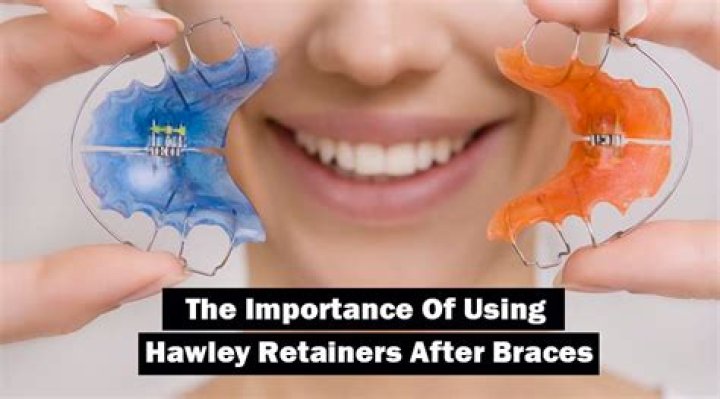 How does a retainer work?