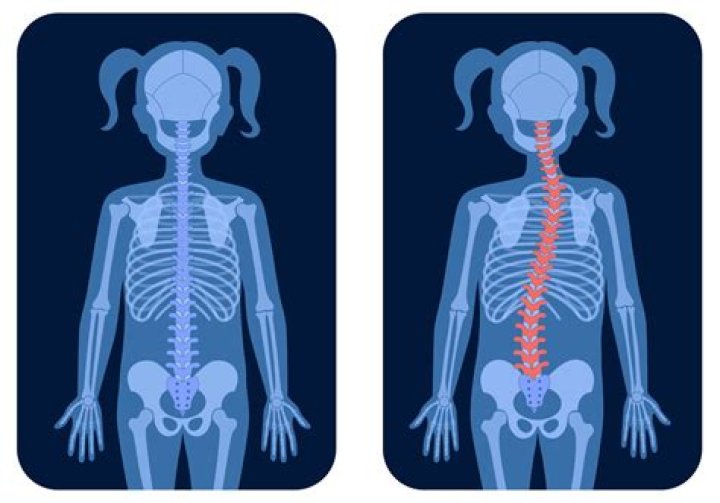 How does scoliosis affect the body?