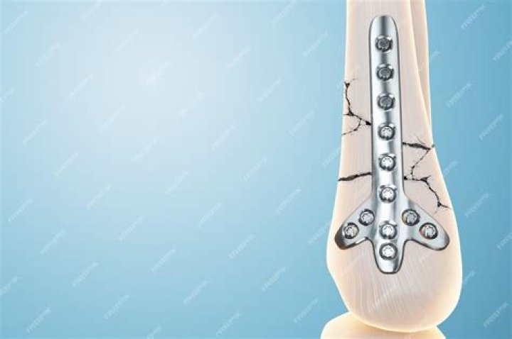 How is osteosynthesis done?