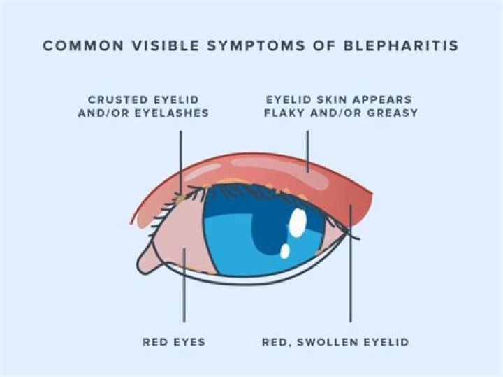 How long does blepharitis last?